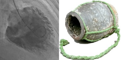 Takotsubo cardiomyopathy: The LV ventriculography (left) resembles an octopus trap (right).